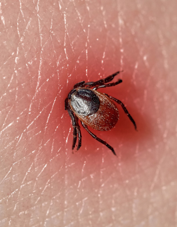 Tick feeding on human skin - Tick Pest Control